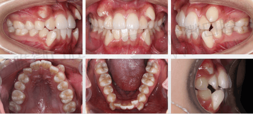 维他灵假牙纯钛牙冠的区别,纯钛牙冠好不好(图1)